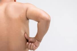Co oznaczają białe plamy na plecach i skórze ciała? Jak je leczyć?
