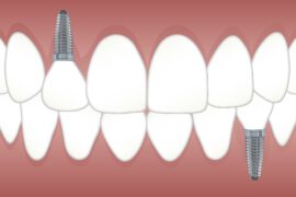 Implanty zębowe - jakie wiąże się z tym ryzyko?