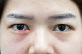 Gronkowiec w oku, w uchu i w nosie – objawy, przyczyny, leczenie