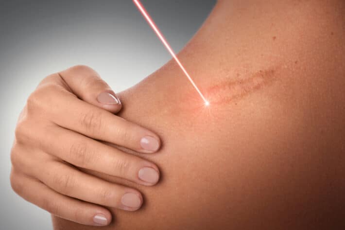 Laserowe usuwanie blizny z ramienia kobiety