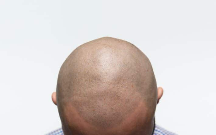 Mikropigmentacja skóry głowy