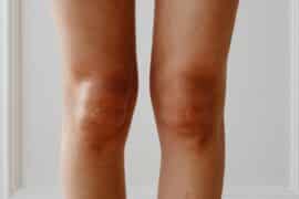 Zapalenie kaletki maziowej w kolanie
