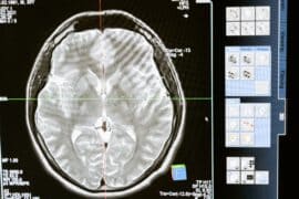 Zapalenie opon mózgowych - wszystko co powinieneś o nim wiedzieć
