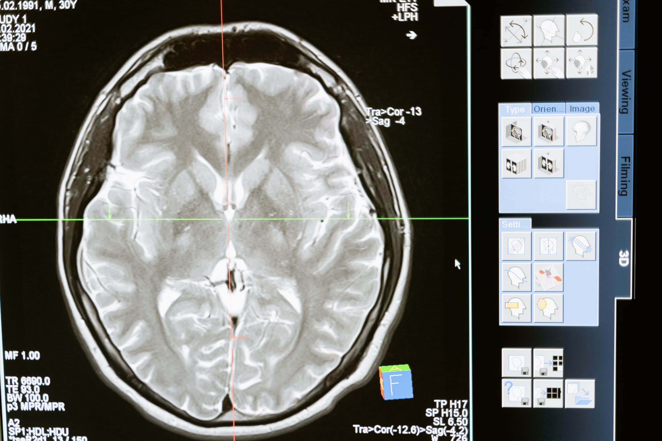 Zapalenie opon mózgowych na zdjęciu rentgenowskim
