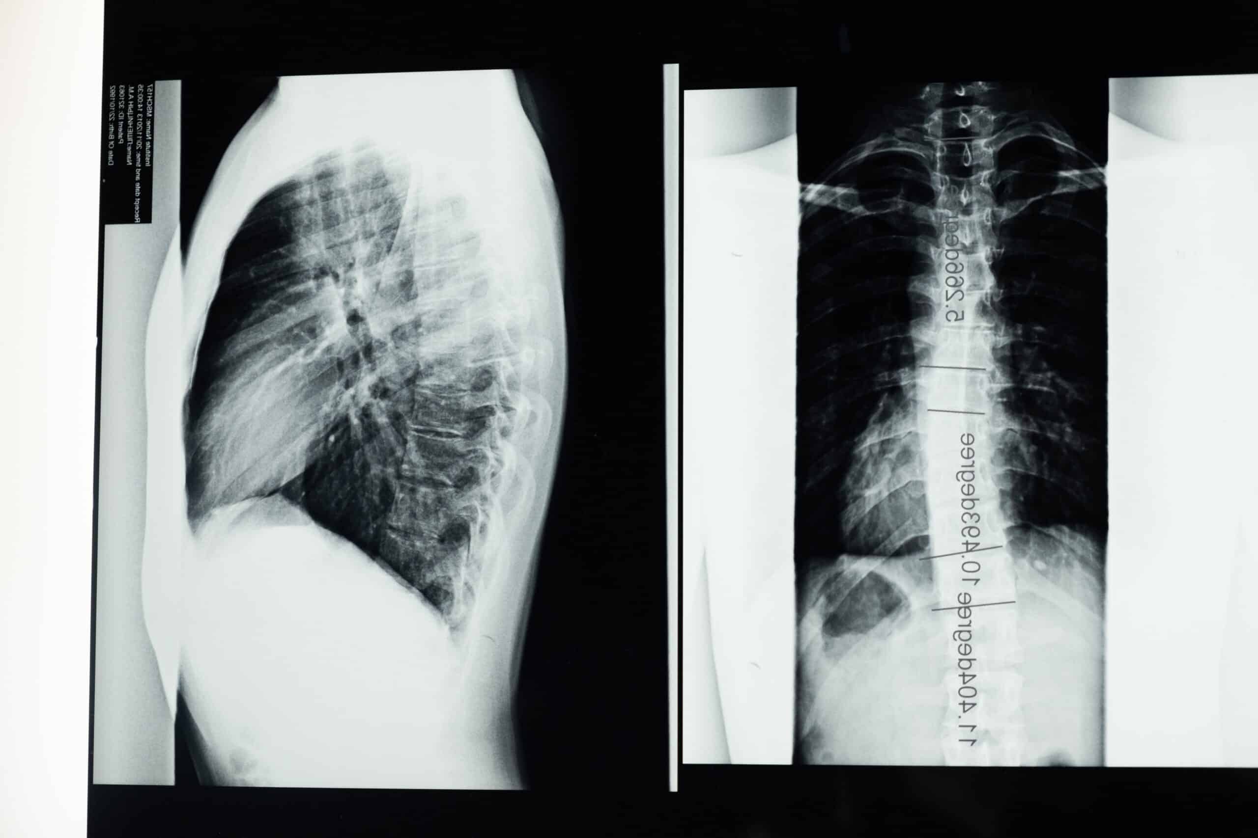 Zdjęcie rentgenowskie skoliozy piersiowej