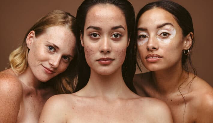 Trzy dorosłe kobiety mają na twarzy trądzik