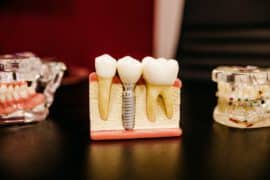 Leczenie kanałowe zębów u stomatologa