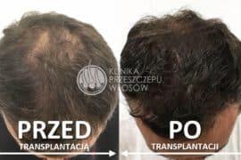 Przeszczep włosów — metody i cena transplantacji włosów