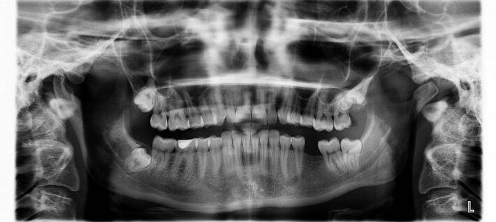 Zrobione zdjęcie RTG zębów u stomatologa