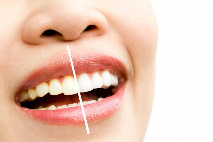 Porównanie kolorytu zębów u młodej kobiety przed i po zabiegu