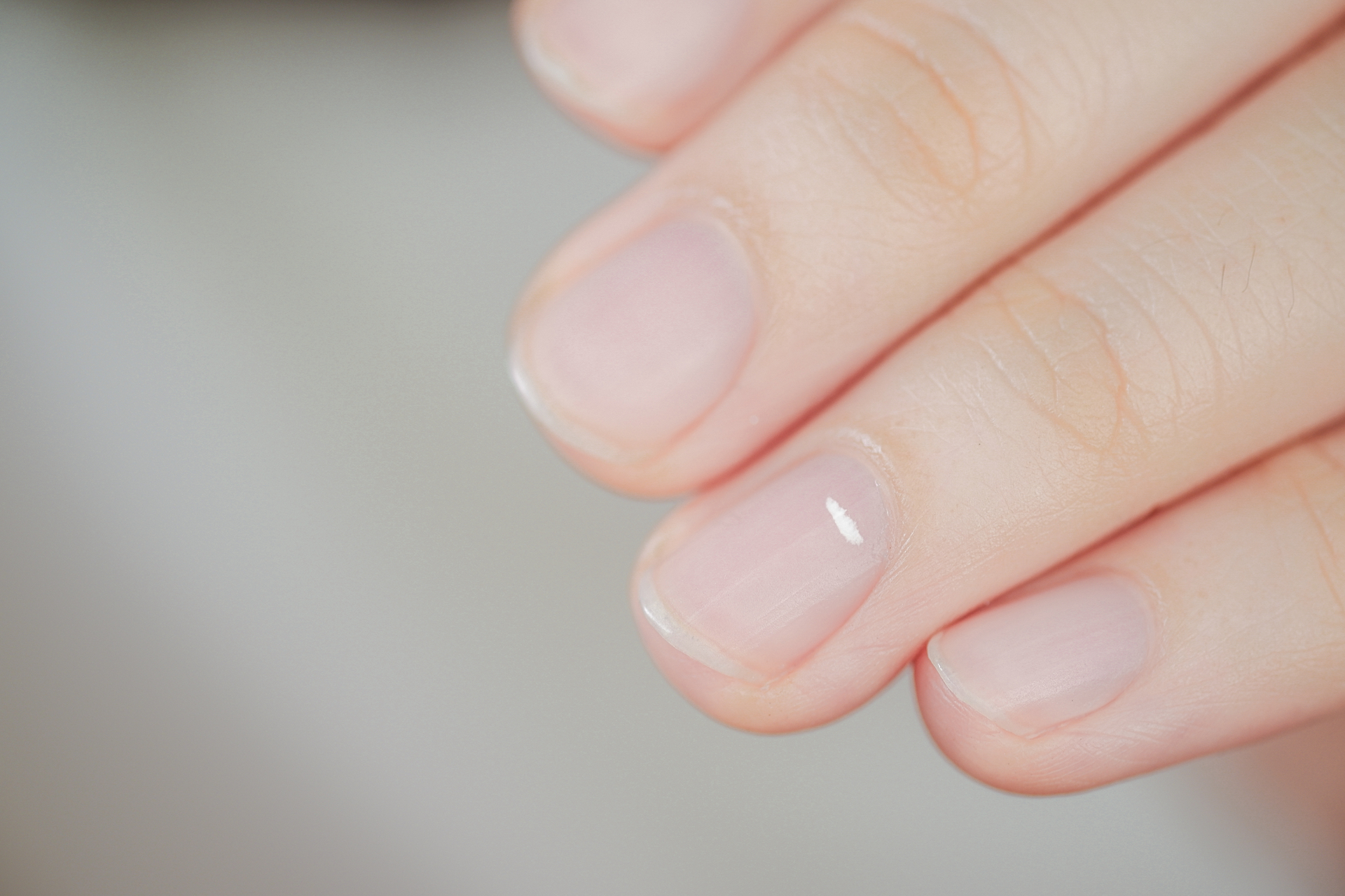 Na tym intrygującym obrazku możemy zobaczyć paznokcie z białymi przebarwieniami, które nadają im niezwykły i unikalny wygląd. Te subtelne białe plamy, rozmieszczone na powierzchni paznokci, tworzą interesujący kontrast i mogą być źródłem zaciekawienia. Przebarwienia te mogą być wynikiem różnych czynników, takich jak infekcje, zaburzenia pigmentacji lub urazy, co sprawia, że paznokcie stają się niepowtarzalne i godne uwagi