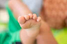Na tym obrazku widzimy stopę dziecka z wyraźnie krzywym palcem, co jest deformacją w obrębie stopy. Ta ilustracja ukazuje problem krzywego palca u nogi u dziecka, który może wpływać na prawidłowe funkcjonowanie i komfort chodzenia. Obrazek stanowi wizualne przedstawienie potrzeby zrozumienia, diagnozowania i odpowiedniego leczenia krzywego palca u nogi u dzieci w celu poprawy zdrowia i jakości życia