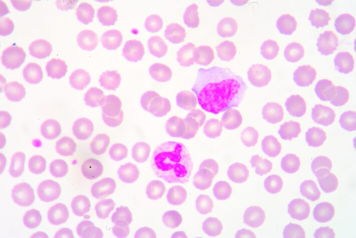 Na tym obrazku widzimy obraz mikroskopowy leukocytów, czyli białych krwinek. Leukocyty są kluczowymi komórkami układu odpornościowego, chroniącymi organizm przed infekcjami i stanami zapalnymi. Obraz ten przedstawia różnorodność i liczbę leukocytów, co jest istotne w diagnostyce i monitorowaniu zdrowia pacjenta