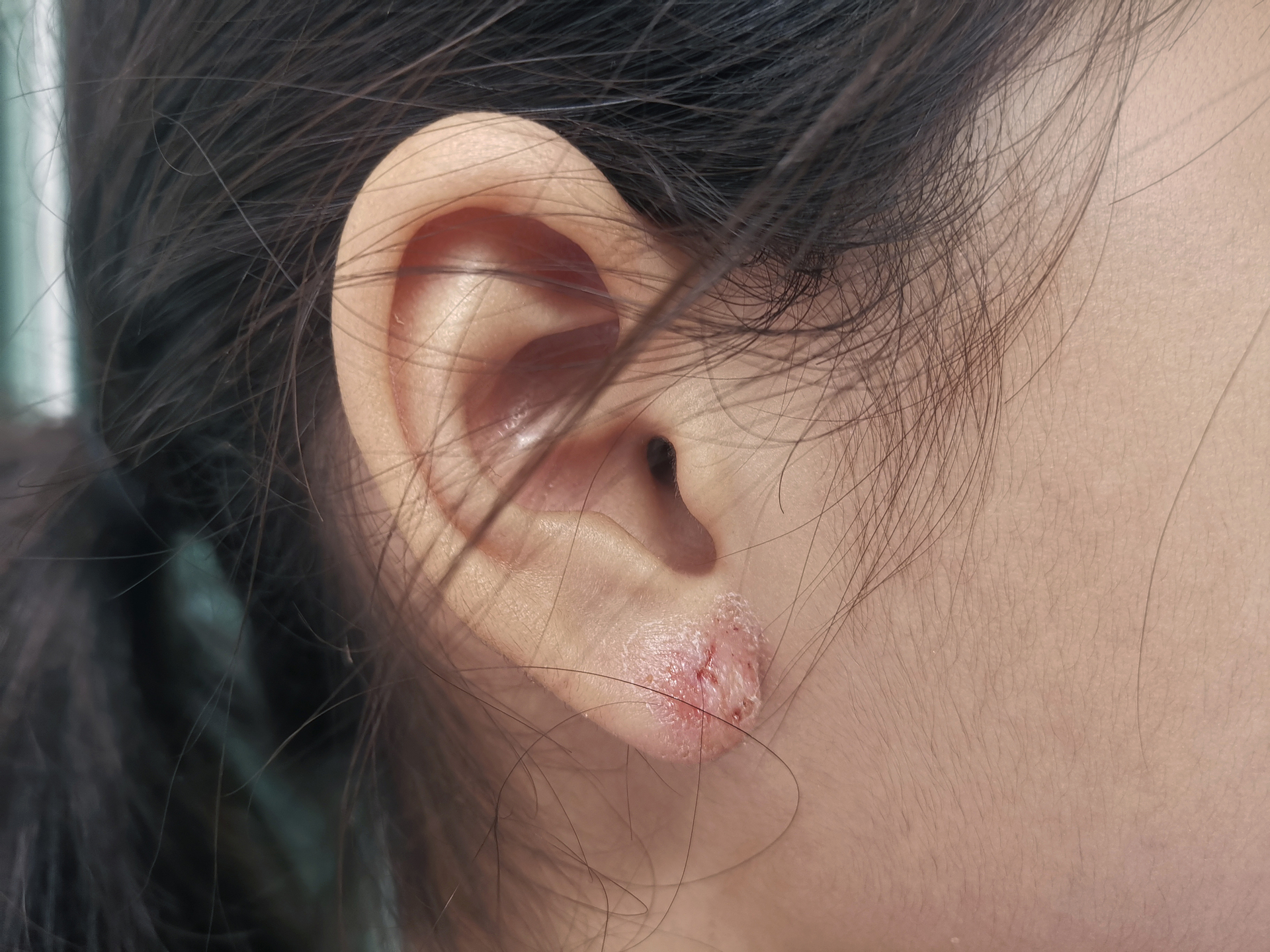 Na tym obrazku widoczna jest kobieta z raną w uchu, która może być wynikiem urazu, zranienia lub innego rodzaju uszkodzenia. Rana jest zauważalna na skórze przewodu słuchowego, powodując ból, zaczerwienienie i możliwe krwawienie. W przypadku takiej rany zaleca się skonsultowanie z lekarzem w celu odpowiedniego leczenia i zapobieżenia ewentualnym powikłaniom