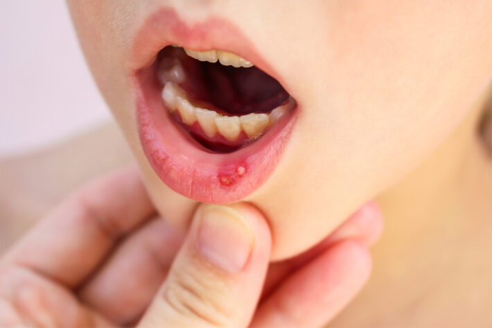 Na tym obrazku widoczna jest dokładnie przedstawiona rana w jamie ustnej, która może być wynikiem różnych czynników, takich jak uraz, owrzodzenie czy infekcja. Rana ta może być bolesna i wpływać na codzienne czynności, takie jak jedzenie czy mówienie. Jednak dzięki odpowiedniej opiece i leczeniu, rana w jamie ustnej może goić się i zapewnić ulgę, przywracając zdrowie i komfort