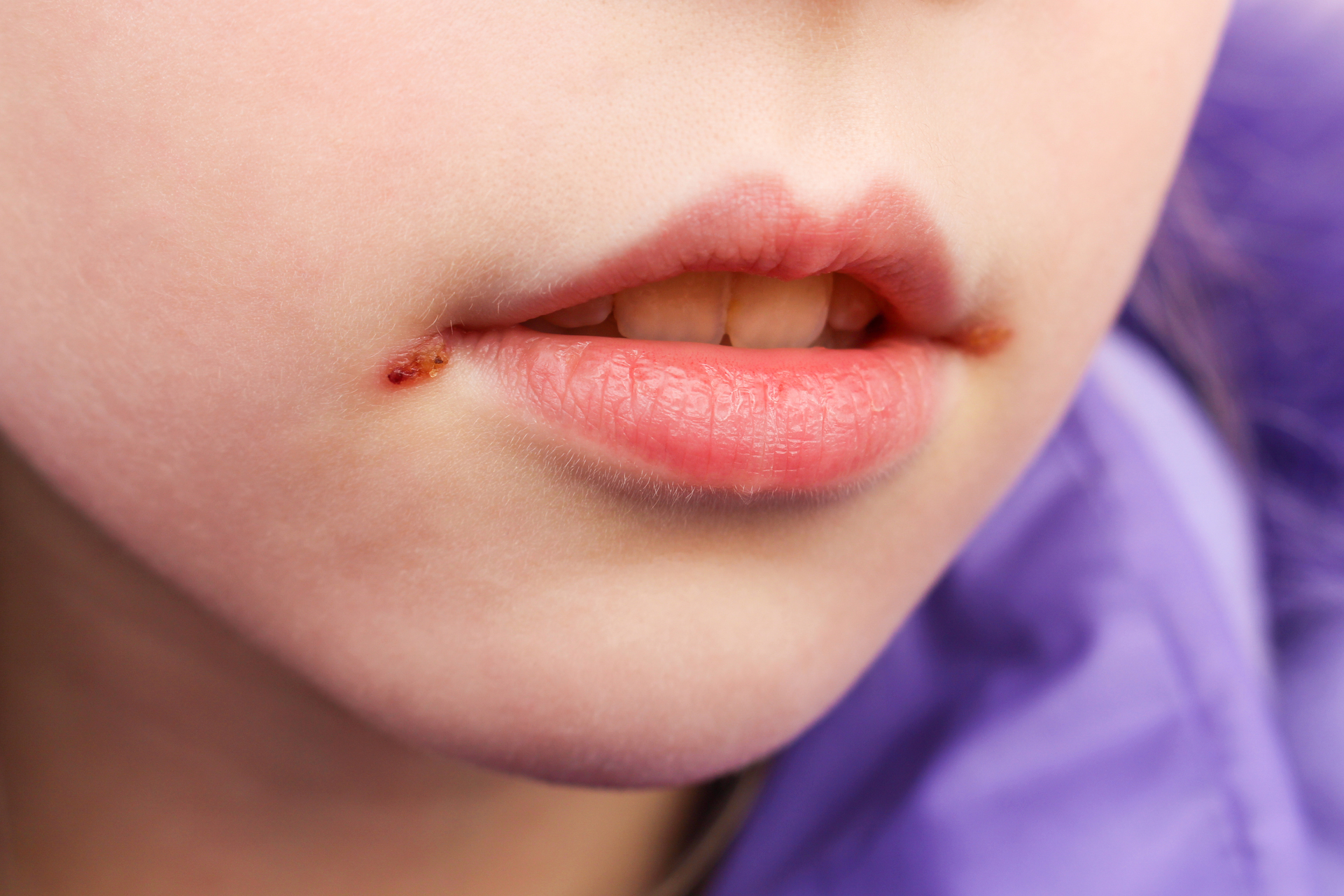 Na tym obrazku przedstawione jest dziecko z zajadami w kącikach ust, które są bolesnymi pęknięciami lub owrzodzeniami skóry. Zajady mogą być spowodowane przez czynniki takie jak infekcje, niedobory witamin lub nawyk lizania warg. Rany w kącikach ust powodują dyskomfort podczas jedzenia i mówienia, dlatego istotne jest skonsultowanie się z lekarzem w celu diagnozy i odpowiedniego leczenia, aby złagodzić objawy i przyspieszyć proces gojenia się