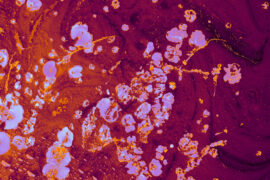 Obrazek przedstawia widok trombocytów u dziecka pod mikroskopem, ukazujący ich charakterystyczne kształty i strukturę. Te małe, krążkowate komórki krwi odgrywają kluczową rolę w procesie krzepnięcia i tworzeniu skrzepów. Obrazek pokazuje imponującą liczbę i gęstość trombocytów, co może wskazywać na możliwą trombocytozę lub inną patologię związana z układem krzepnięcia