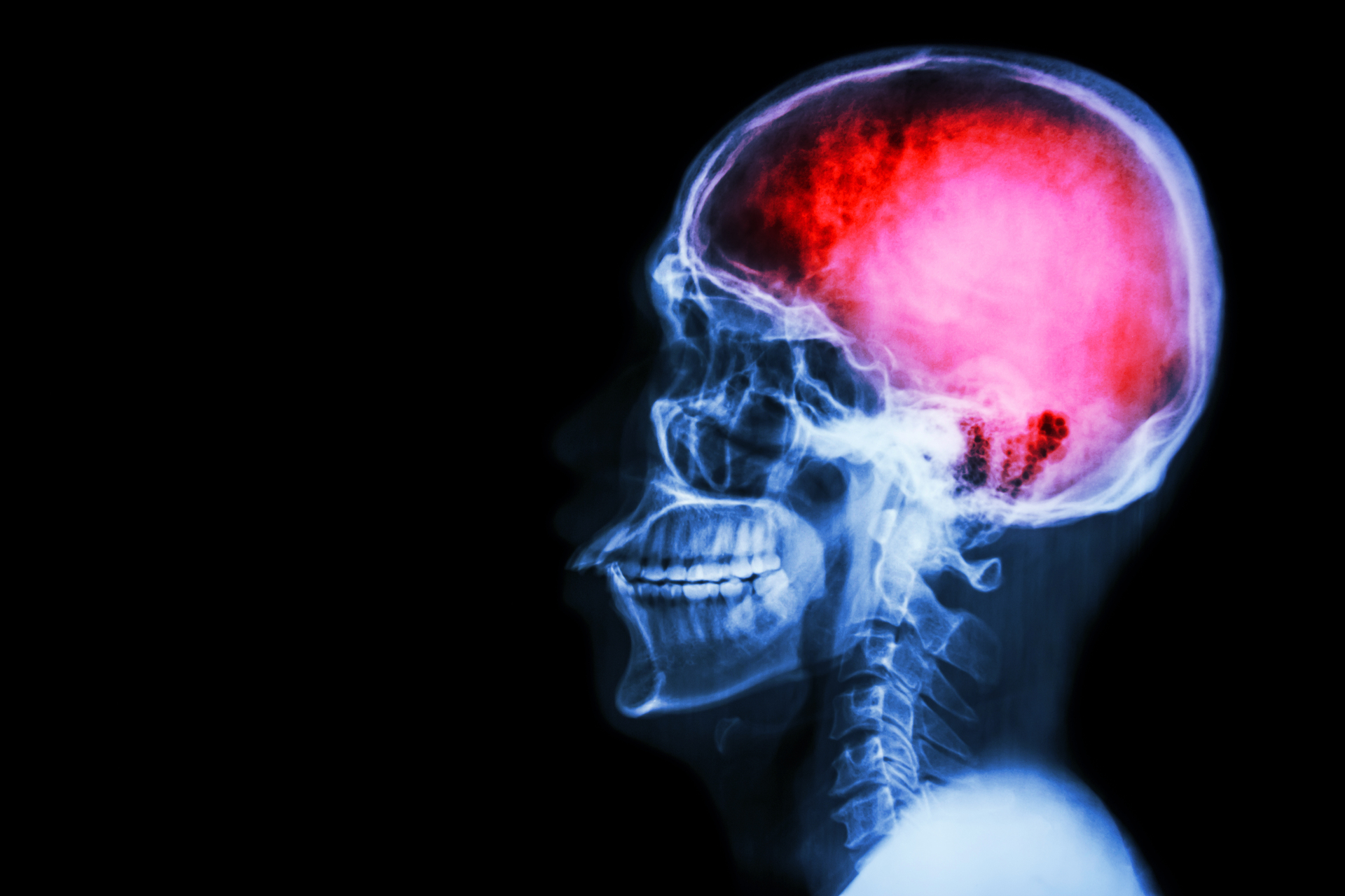 Na tym obrazku widzimy rentgenowskie zdjęcie mózgu, które ukazuje obszar dotknięty udarem. Jasno zaznaczone obszary niedokrwienia wskazują na uszkodzenie tkanek mózgowych. Widoczne zmiany na zdjęciu obrazują poważne konsekwencje udaru mózgu i mogą służyć jako narzędzie diagnostyczne dla lekarzy. To zatrważające zdjęcie rentgenowskie przypomina nam o pilnej potrzebie rozpoznawania i leczenia udarów w celu minimalizacji ich skutków dla pacjentów