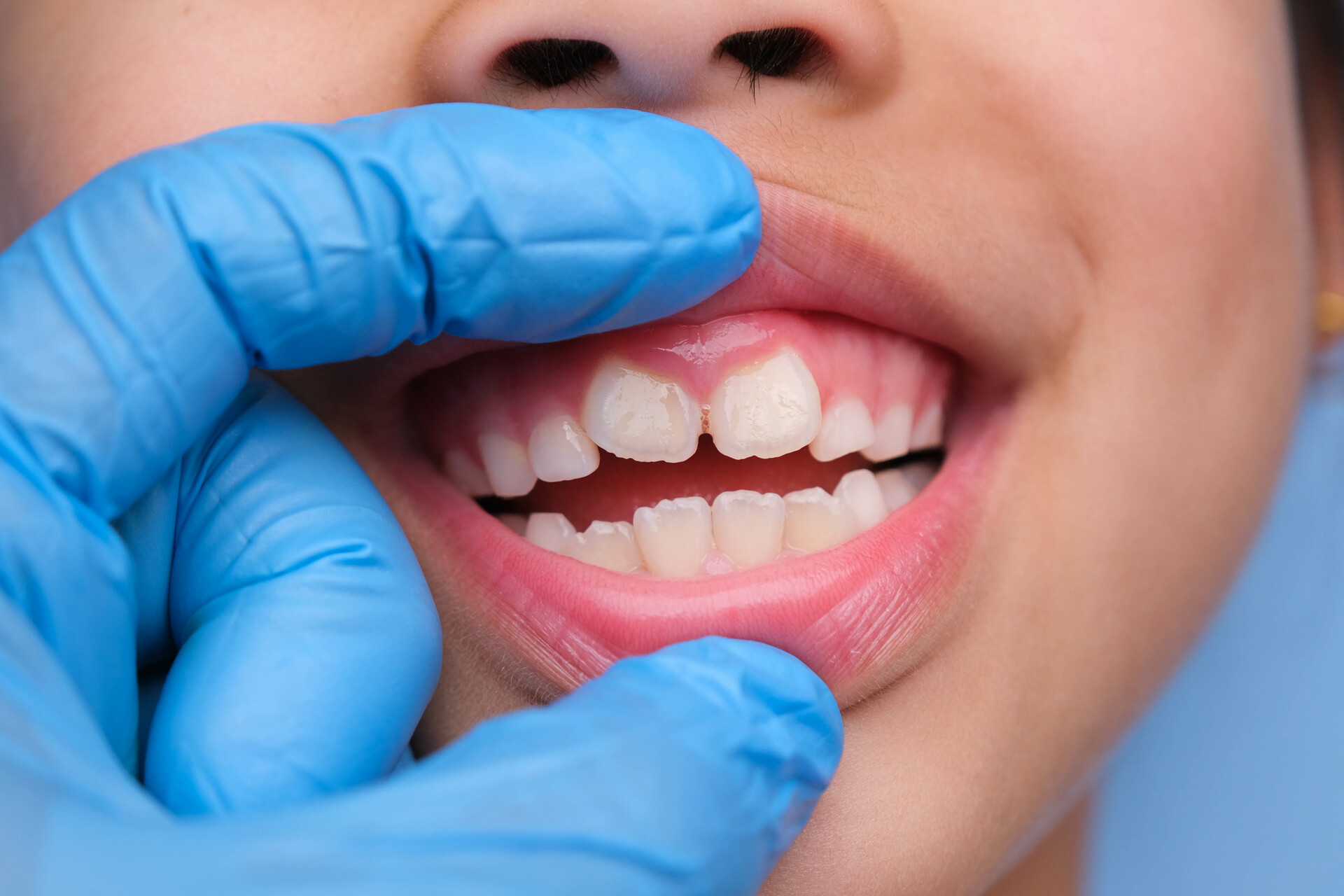Obrazek przedstawia uśmiechnięte dziecko z białymi plamkami na zębach, które wymagają uwagi i troski. Plamki te mogą być wynikiem różnych czynników, takich jak nadmiar fluoru lub odwapnienie szkliwa. Pomimo tego, uśmiech dziecka jest wciąż uroczy i pełen radości, a z odpowiednią opieką i leczeniem można przywrócić mu zdrowe i piękne zęby