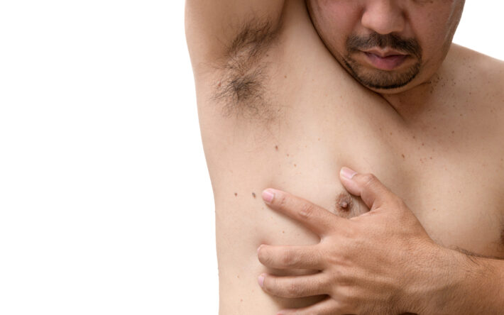 Obrazek przedstawia męską klatkę piersiową z krostkami na sutkach, które mogą być wynikiem różnych czynników, takich jak trądzik lub łojotokowe zapalenie gruczołów sutkowych. Krostki te mogą powodować dyskomfort i zmartwienie, jednak odpowiednia pielęgnacja i leczenie mogą pomóc w ustąpieniu objawów. Pomimo obecności krostek, męska klatka piersiowa wciąż emanuje siłą i męskością